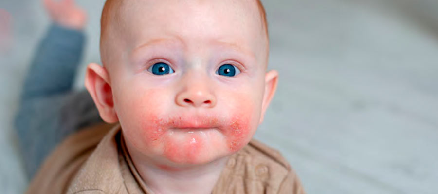 Rostro un bebé con eczema